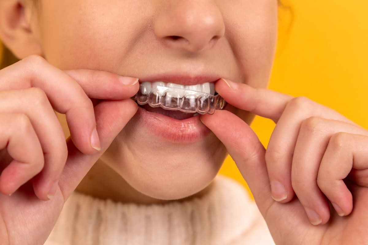 Placa de bruxismo